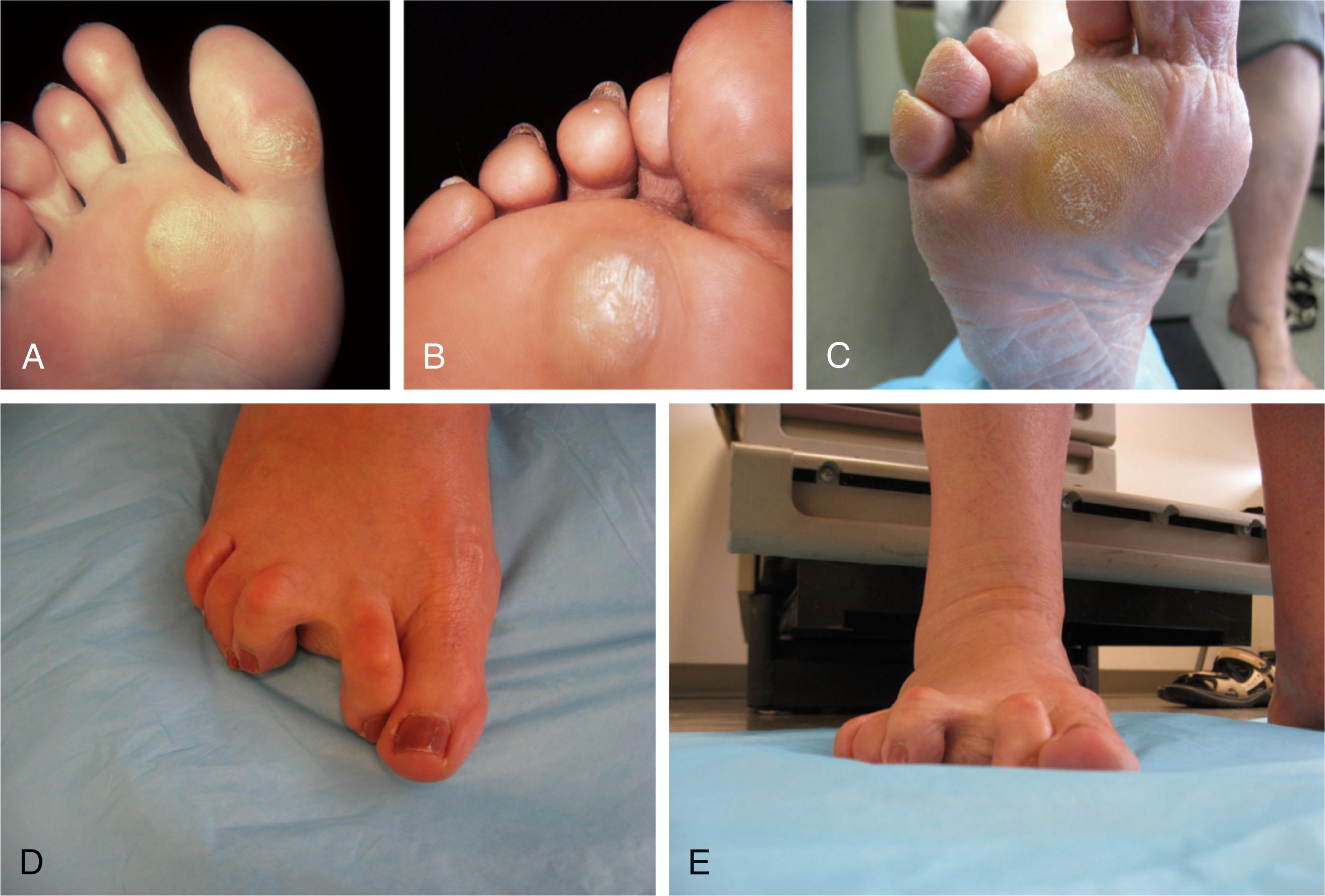 Fig. 13-18, A and B , Examples of diffuse keratotic lesions. When these lesions are debrided, there is no central core, which distinguishes them from discrete keratotic lesions. C , Diffuse callus formation under second and third metatarsophalangeal (MTP) joints resulting from second crossover toe deformity. D and E , Clinical photographs of patient in C with second crossover toe deformity.