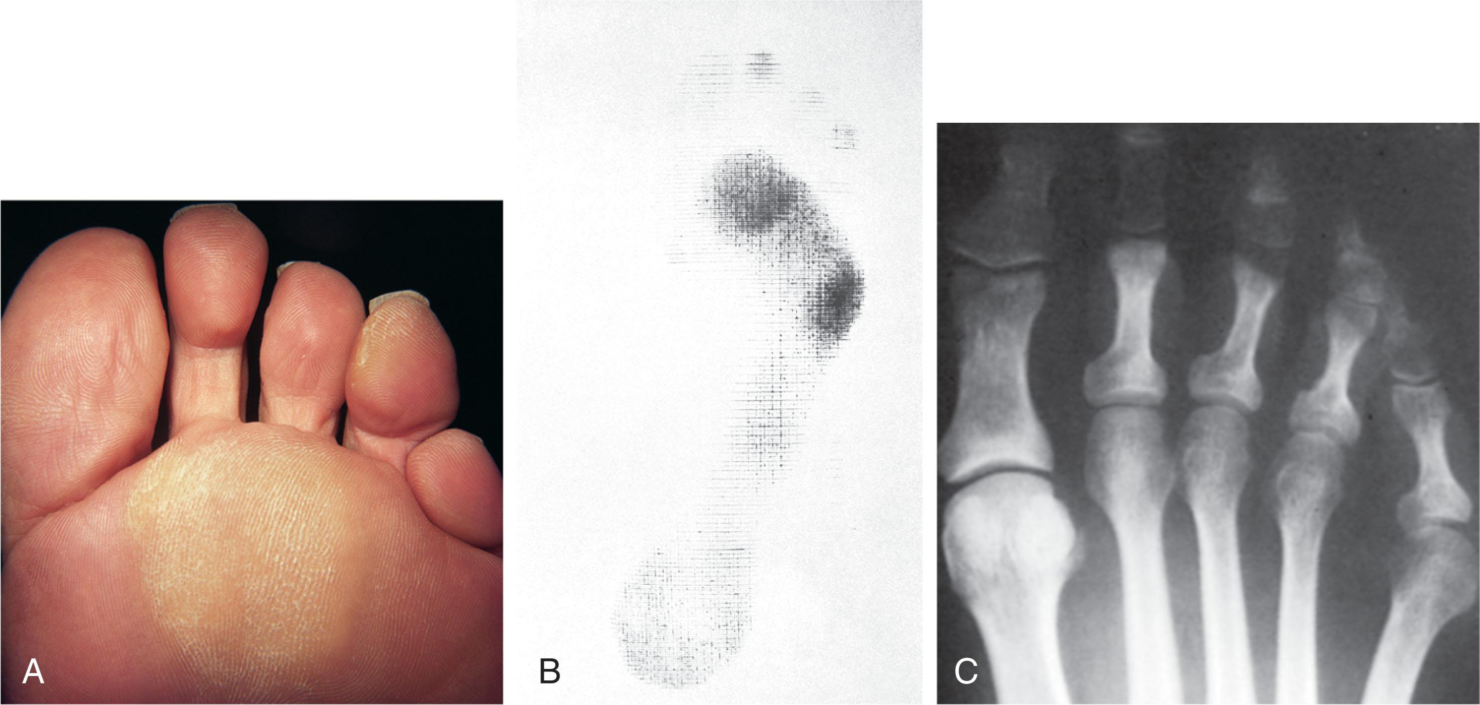 Fig. 13-19, Typical findings with Morton foot (toe). A , Plantar aspect demonstrates diffuse callus beneath second and third metatarsal heads. B , Harris mat print demonstrates increased weight bearing beneath the second and third metatarsals, with little or no weight bearing beneath the first metatarsal head. C , Radiograph demonstrates typical Morton foot with short first metatarsal and relatively long second and third metatarsals.