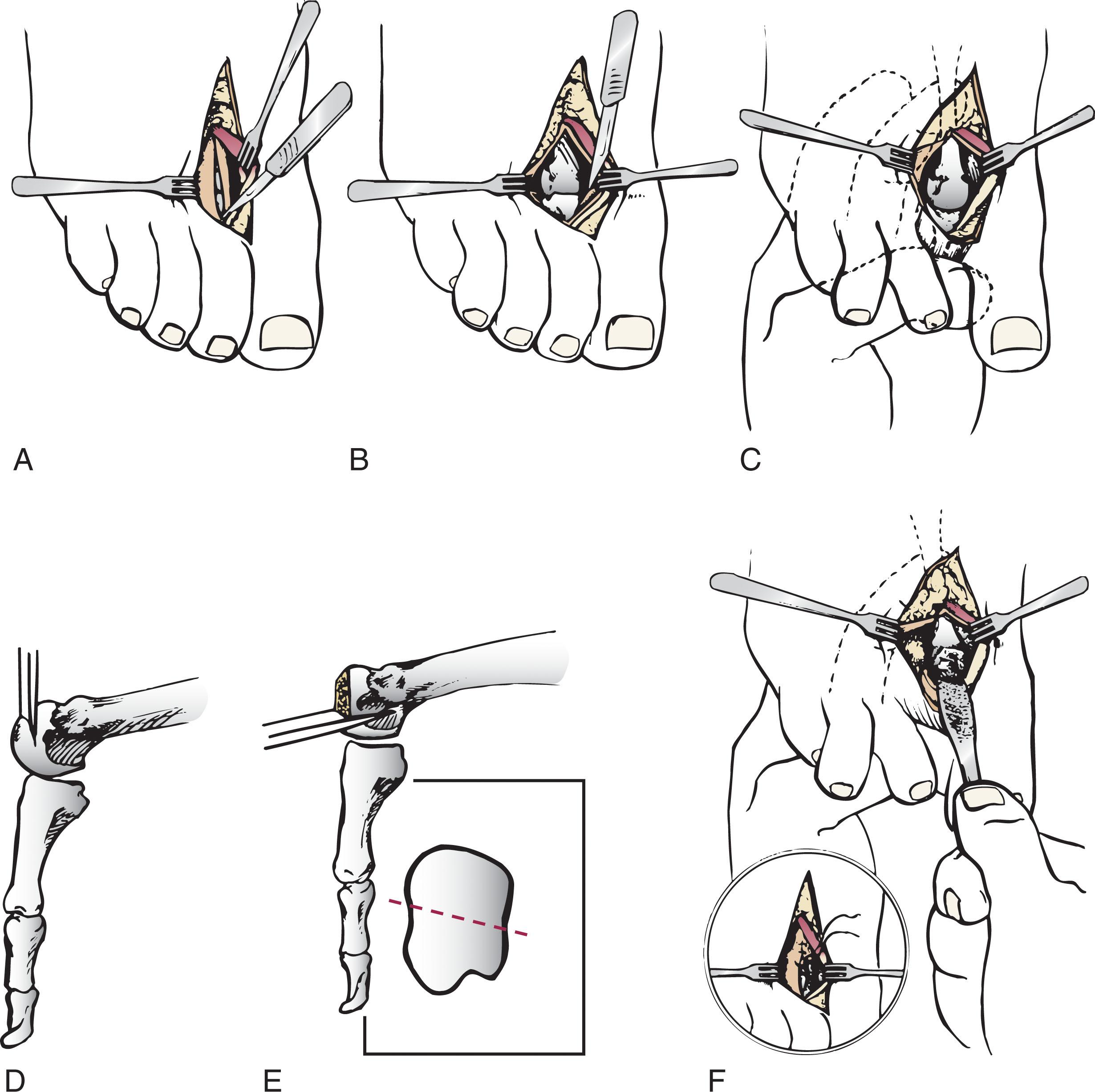 Fig. 13-20, DuVries plantar metatarsal condylectomy. A , Hockey stick–shaped incision beginning in the web space is carried obliquely across the joint to about the middle of the metatarsal shaft. Skin and extensor tendons are retracted, and the capsule is incised longitudinally. B , Capsule and collateral ligaments on both sides of the metatarsal head are sectioned. C , The involved toe is plantar flexed with the left thumb while pressure is applied on the plantar aspect of the metatarsal shaft with the index finger. D , About 2 mm of articular cartilage is removed. E , The plantar 30% of the condyle is removed with an osteotome. Note angulation to facilitate removal of more of the fibular aspect. F , Edges of the metatarsal are smoothed; then the capsule and skin are closed.