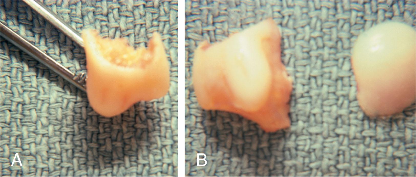 Fig. 13-21, Excised plantar condyle. A , Note marked prominence of the fibular portion of the condyle in this specimen. B , Plantar view of the same specimen illustrating the large condyle.