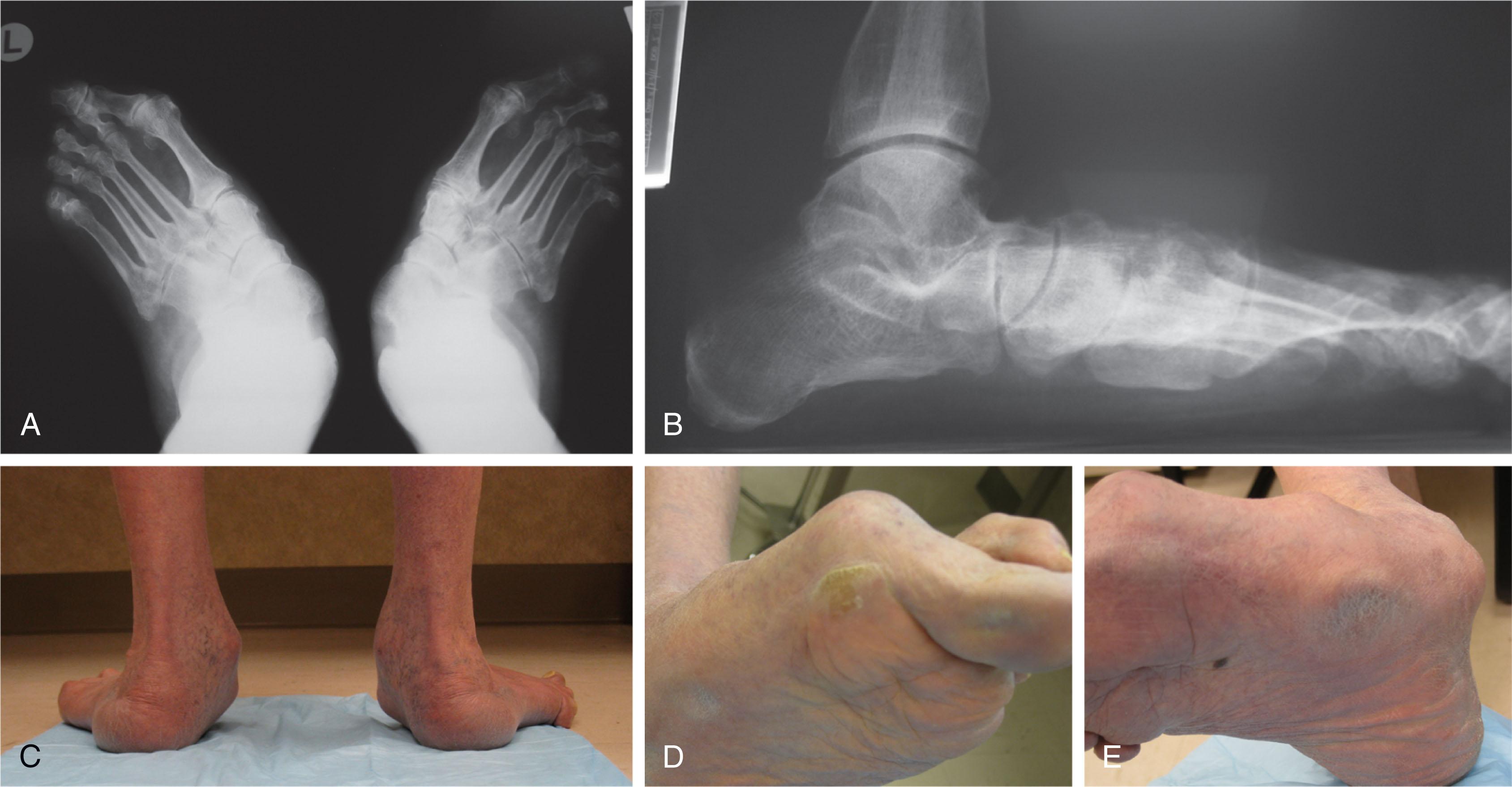 Fig. 13-3, A and B , Radiographs of a patient with a severe pes planovalgus deformity. C , Clinical photograph of same patient demonstrating the deformity when viewed from the posterior aspect. D , Callus formation under first metatarsophalangeal (MTP) joint from inadequate weight bearing of medial column. E , Callus formation under first metatarsocuneiform (MTC) joint from collapse of medial longitudinal arch.