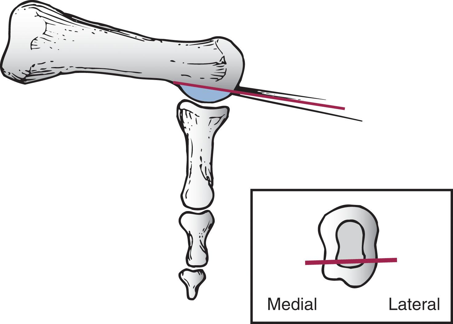 Fig. 13-22, Coughlin modification of plantar condylectomy. Plantar 20% to 30% of the condyle is removed, and the distal portion of the metatarsal head is left intact.