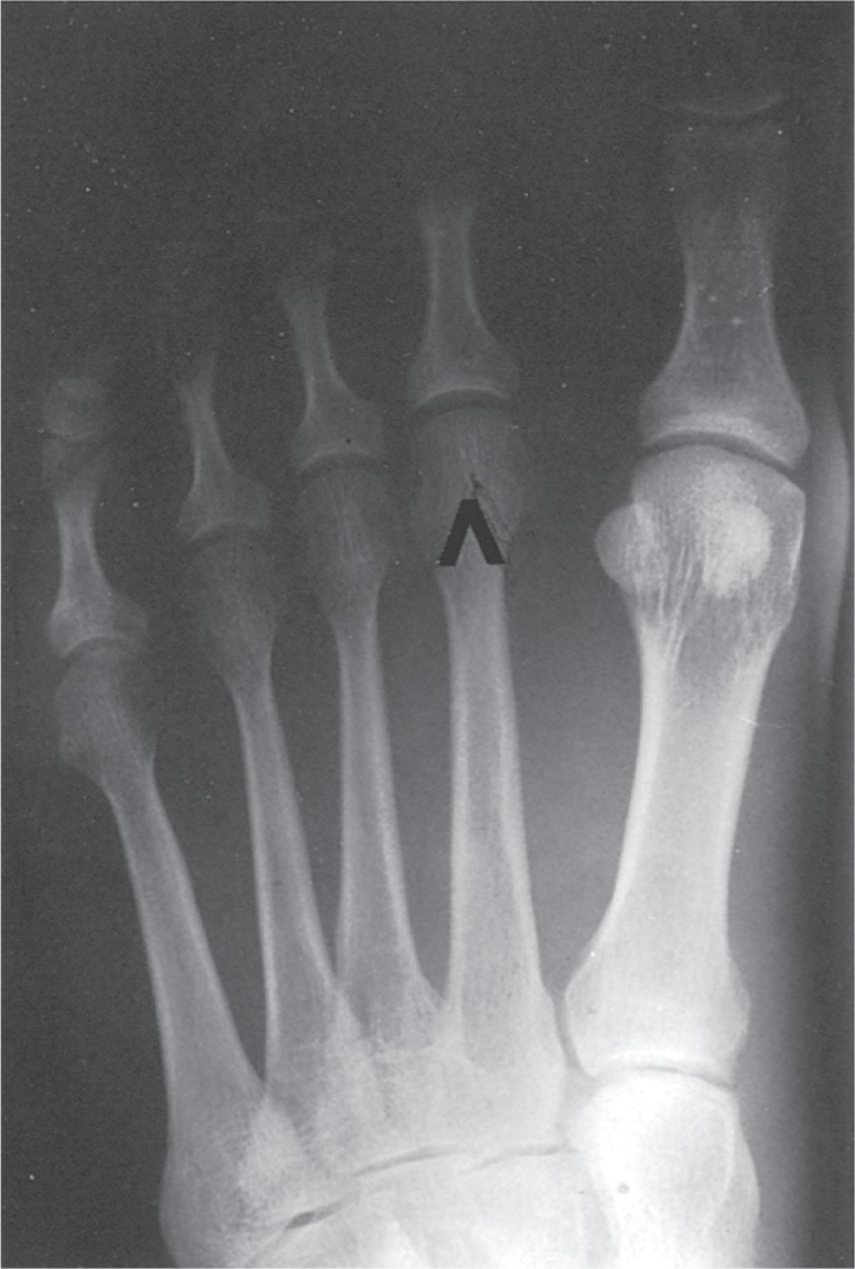 Fig. 13-23, The vertical Chevron procedure is carried out to create an osteotomy, as demonstrated in this radiograph. The metatarsal head should be elevated approximately 3 mm.