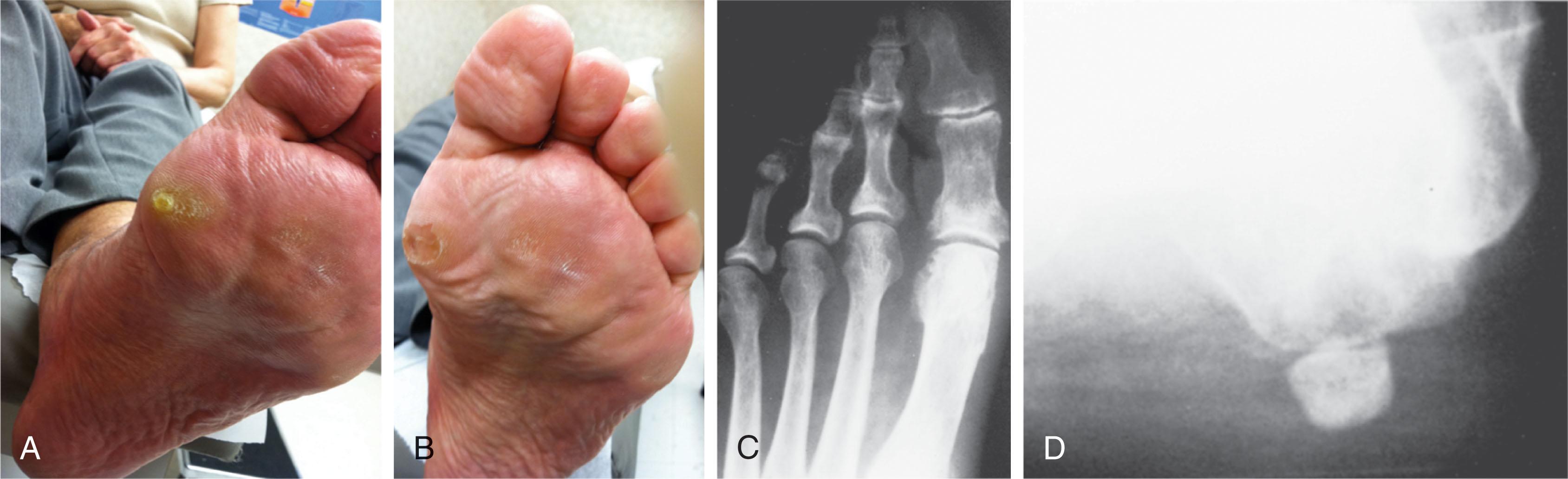 Fig. 13-24, A and B , Discrete keratotic lesion beneath tibial sesamoid before and after debridement. C , Radiograph demonstrates a tibial sesamoid centered beneath the metatarsal head. D , Axial view demonstrates a sesamoid sitting beneath the crista.