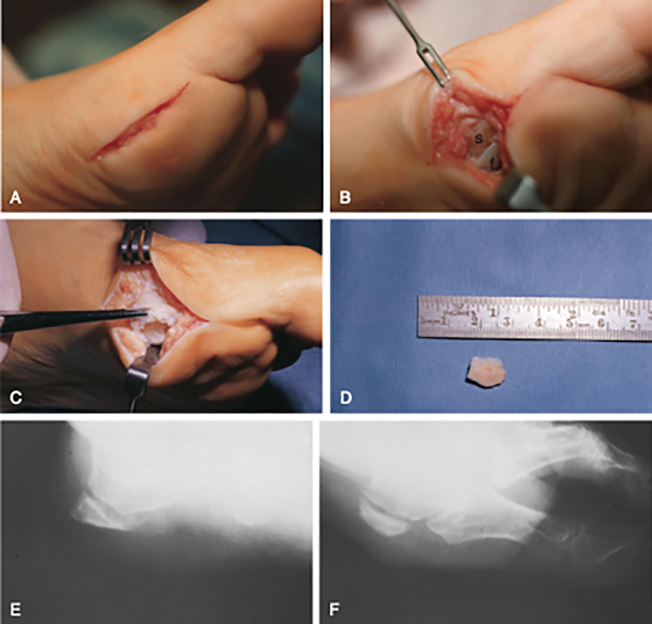 Fig. 13-25, Tibial sesamoid shaving. A , Skin incision is made just below the midline and carried down to expose the joint capsule. The plantar medial cutaneous nerve is identified and retracted. B , After the tibial sesamoid is exposed, the plantar half is removed ( s , sesamoid; f , flexor hallucis longus tendon). C , Appearance after excision of the plantar aspect of the tibial sesamoid. D , Excised piece of the tibial sesamoid. E and F , Axial and lateral radiographs demonstrate tibial sesamoid after removal of the plantar half.