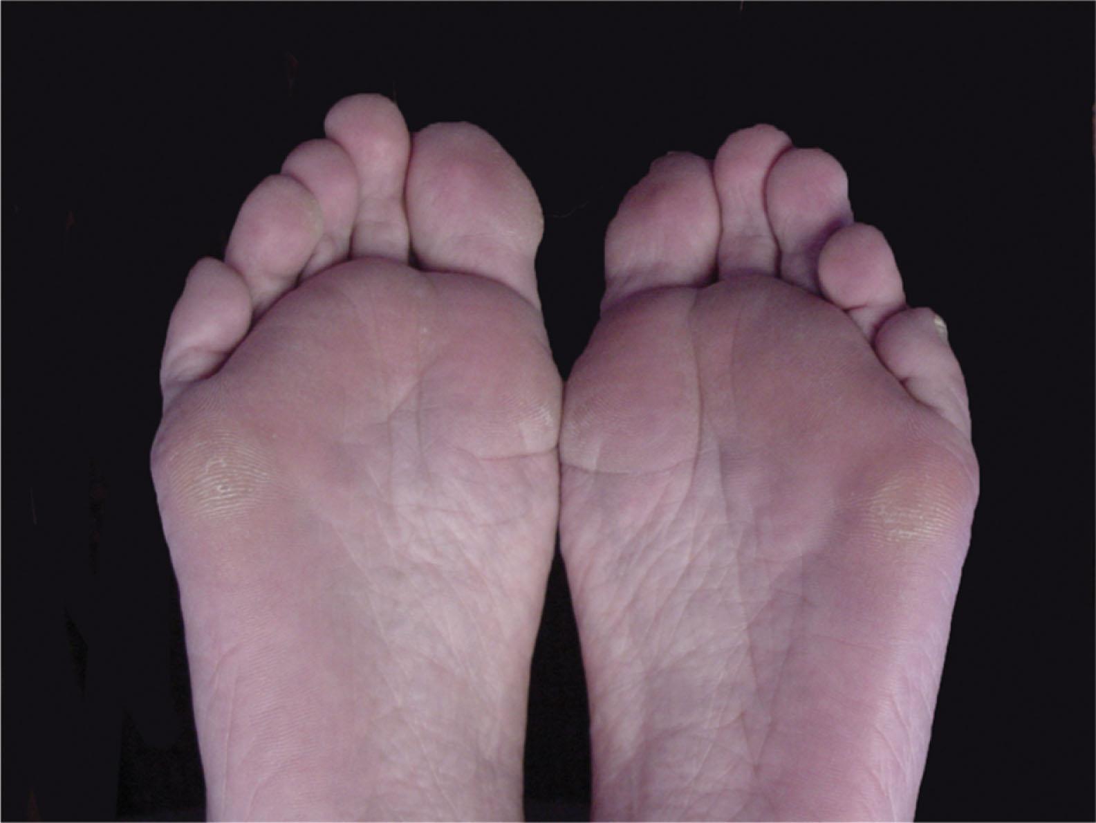 Fig. 13-4, Cavovarus deformity leads to lateral column overload and intractable plantar keratoses of along the fifth metatarsal from the head to the base.