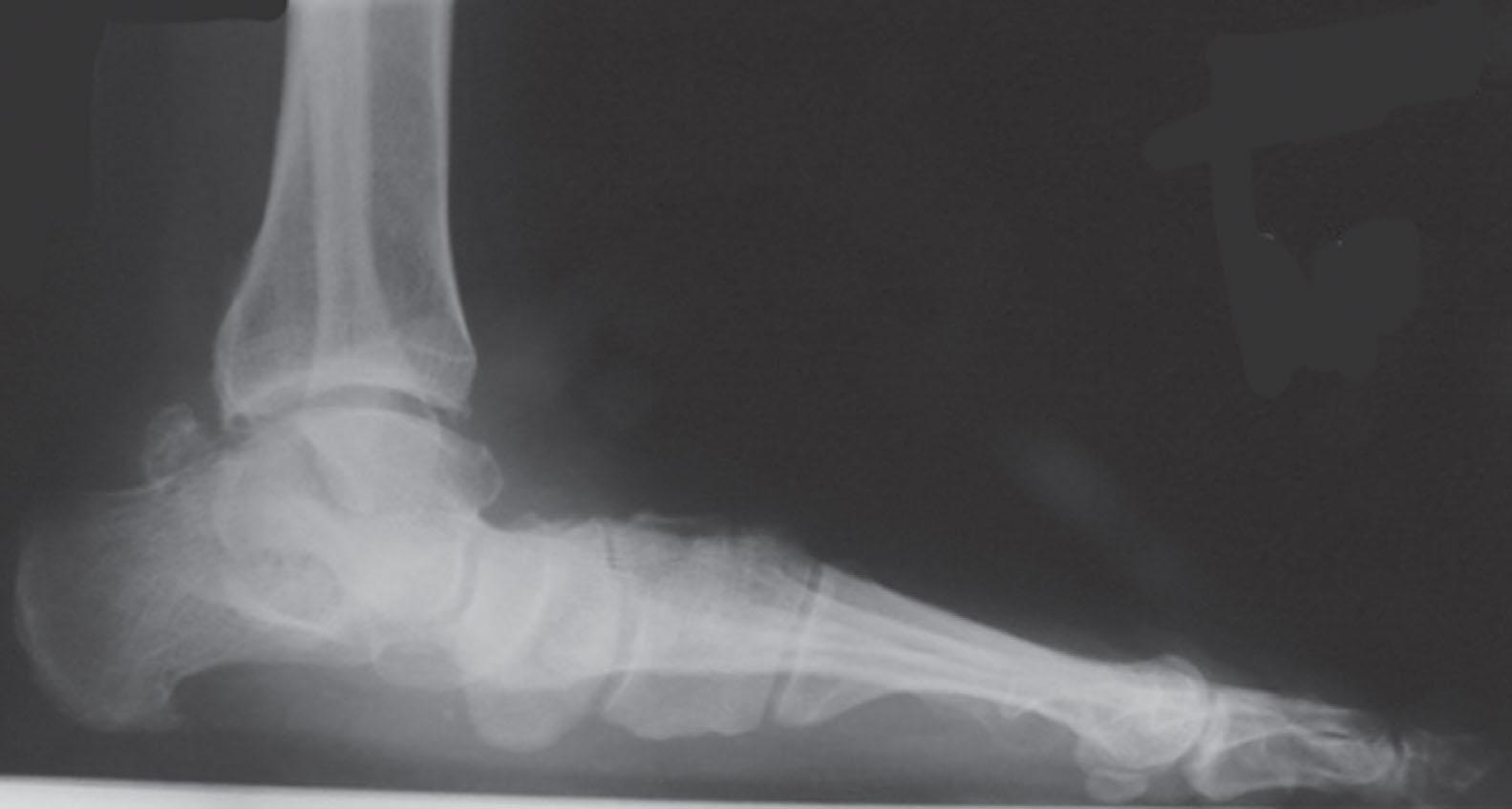 Fig. 13-5, Severe planovalgus foot deformities result in plantar subluxation of the talar head and weight bearing on the medial arch.