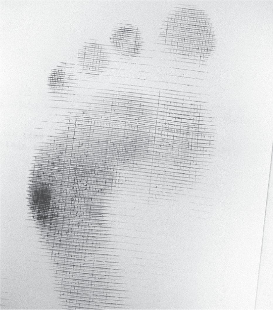 Fig. 13-6, Harris mat print of patient with varus forefoot deformity. Note that pressure is borne on the lateral aspect of the foot, with significantly decreased weight bearing beneath the medial aspect of the foot.