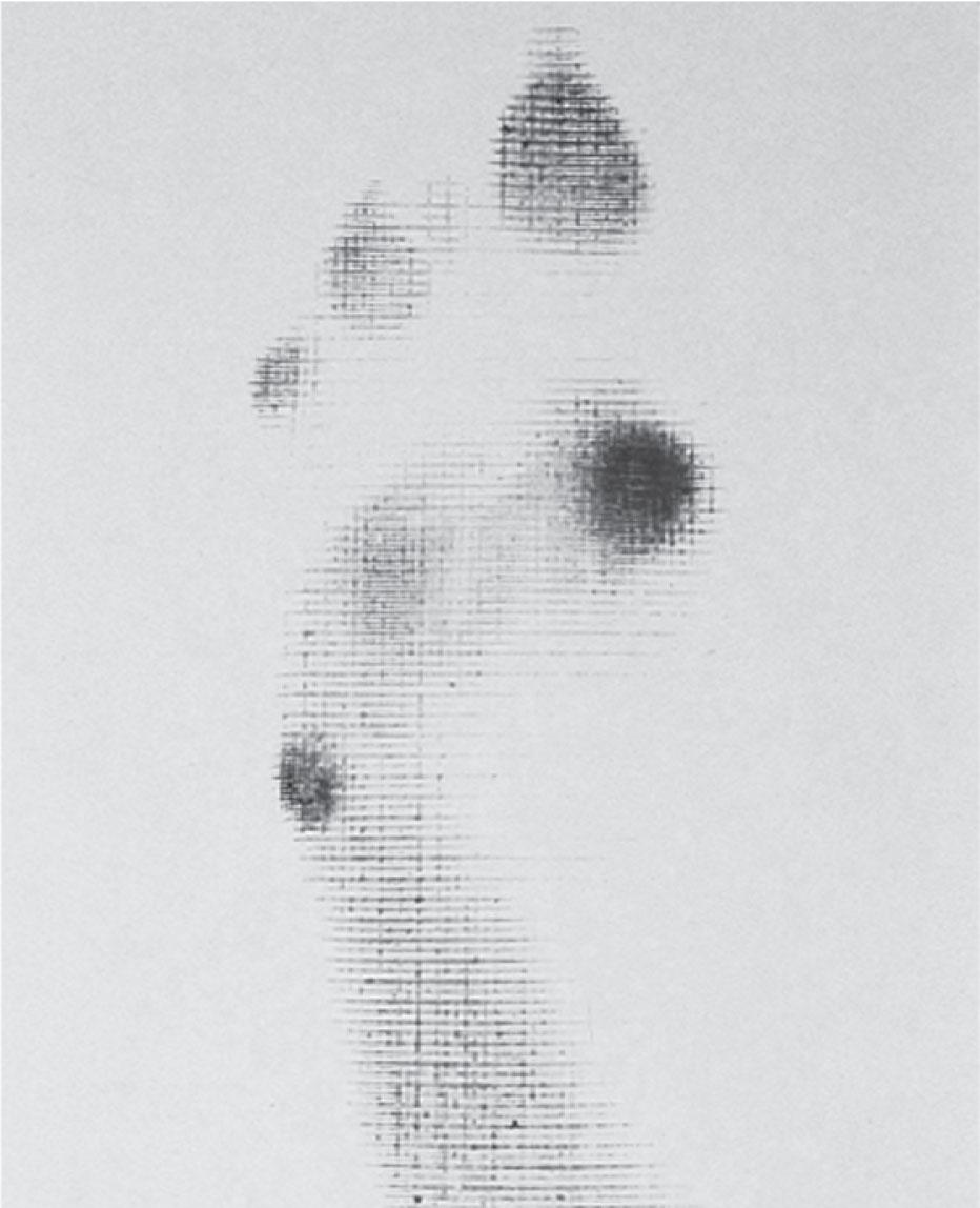 Fig. 13-7, Harris mat print of patient with valgus forefoot deformity in which increased weight is borne along the medial side of the foot and, in particular, beneath the first metatarsal head.