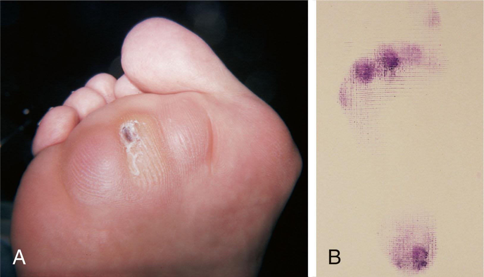 Fig. 13-8, A , Foot in a patient with rheumatoid arthritis with large diffuse plantar calluses beneath the metatarsal heads and nonfunctional toes. B , Harris mat print demonstrating concentration of pressure beneath metatarsal heads and lack of weight bearing by lesser toes.