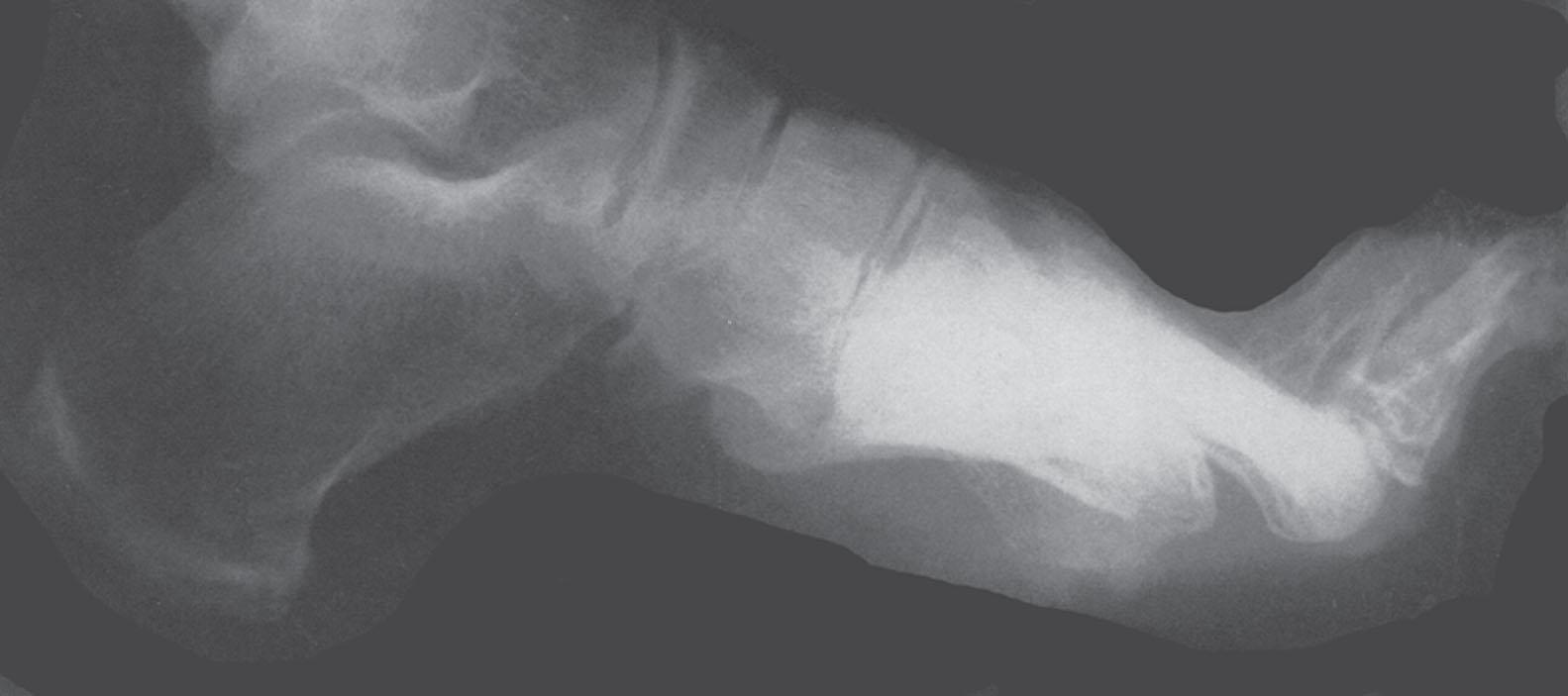 Fig 13-9, Motor imbalance can lead to foot deformities including cavus and clawing of the toes. These deformities accentuate pressure on the metatarsal heads.