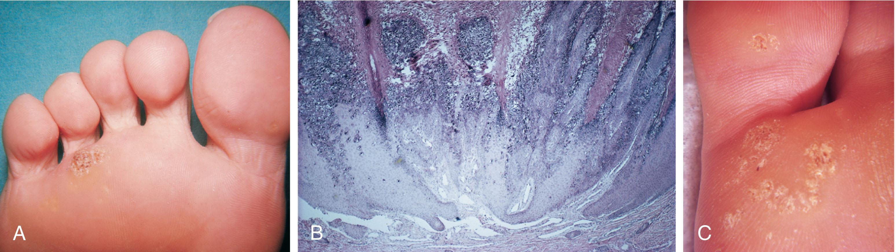 Fig. 13-10, A , Wart on the plantar aspect of the foot does not usually occur on a weight-bearing area. B , Histologic features of the wart demonstrate considerable vascularity within the lesion. C , Mosaic wart has similar histology but is more widespread.