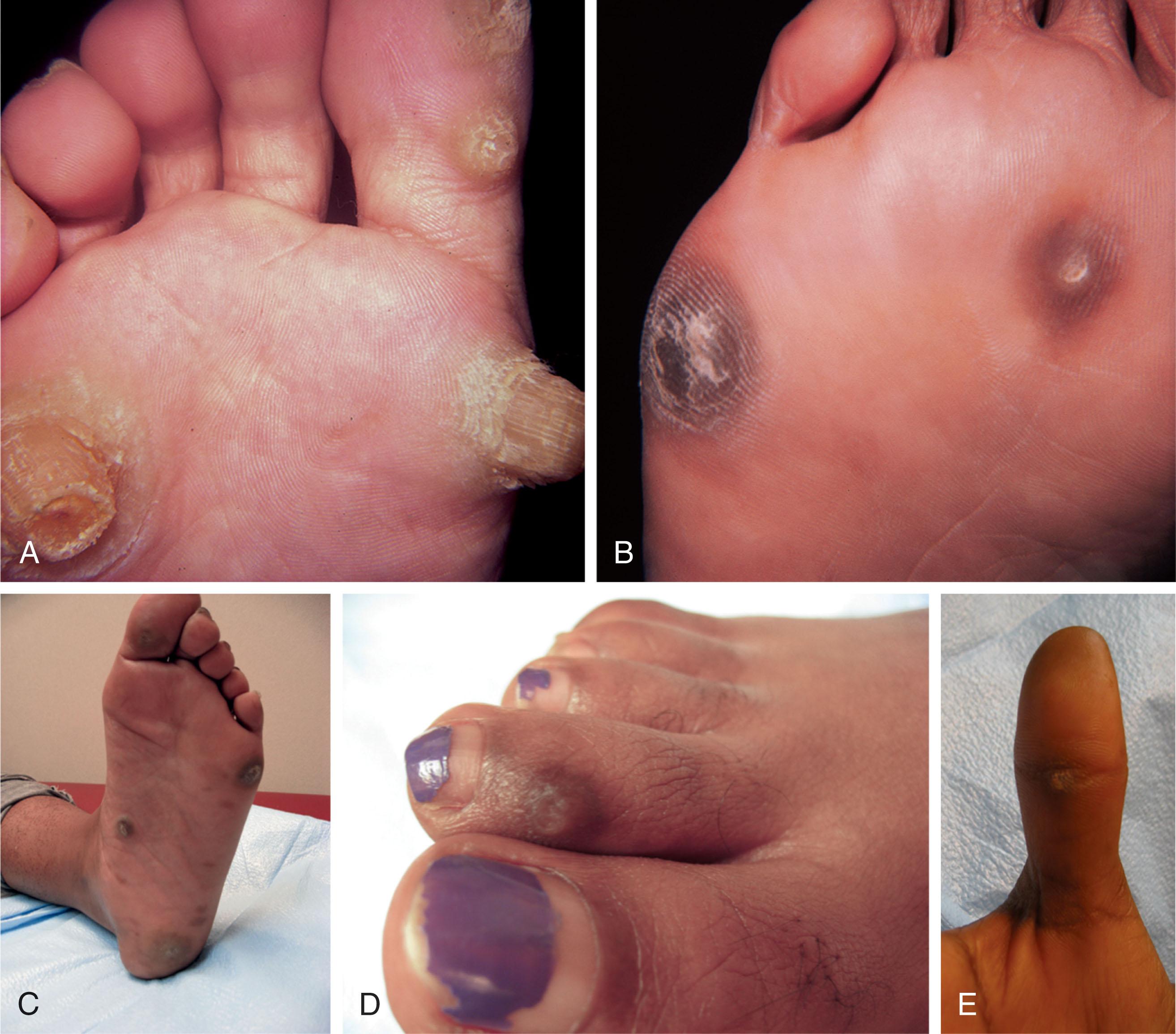 Fig. 13-11, A and B , Examples of feet with hyperkeratotic skin. C and D , Plantar hyperkeratotic lesions consistent with keratosis palmoplantaris nummularis. E , The same patient in C and D also had painful keratotic lesions on her hands, such as this lesion on the volar interphalangeal (IP) flexion crease of the thumb.