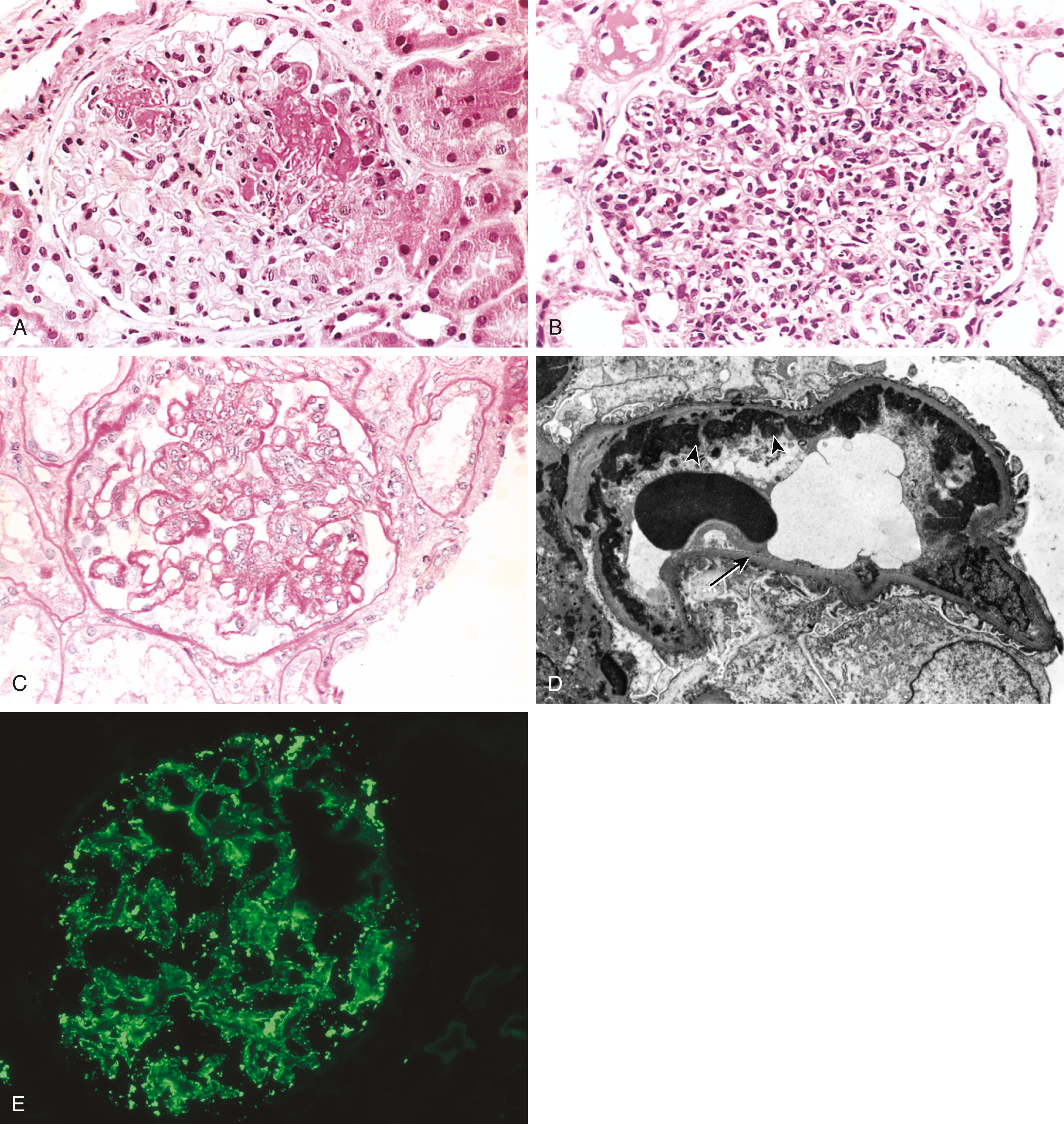 FIG. 12.11, Lupus nephritis. (A) Focal proliferative glomerulonephritis, with two focal necrotizing lesions at the 11 o’clock and 2 o’clock positions (H&E stain). Extracapillary proliferation is not prominent in this case. (B) Diffuse proliferative glomerulonephritis. Note the marked increase in cellularity throughout the glomerulus (H&E stain). (C) Lupus nephritis showing a glomerulus with several “wire-loop” lesions representing extensive subendothelial deposits of immune complexes (PAS stain). (D) Electron micrograph of a renal glomerular capillary loop shows subendothelial dense deposits (arrowhead) on basement membrane (arrow) that correspond to “wire loops” seen by light microscopy. (E) Deposition of IgG antibody in a granular pattern, detected by immunofluorescence.