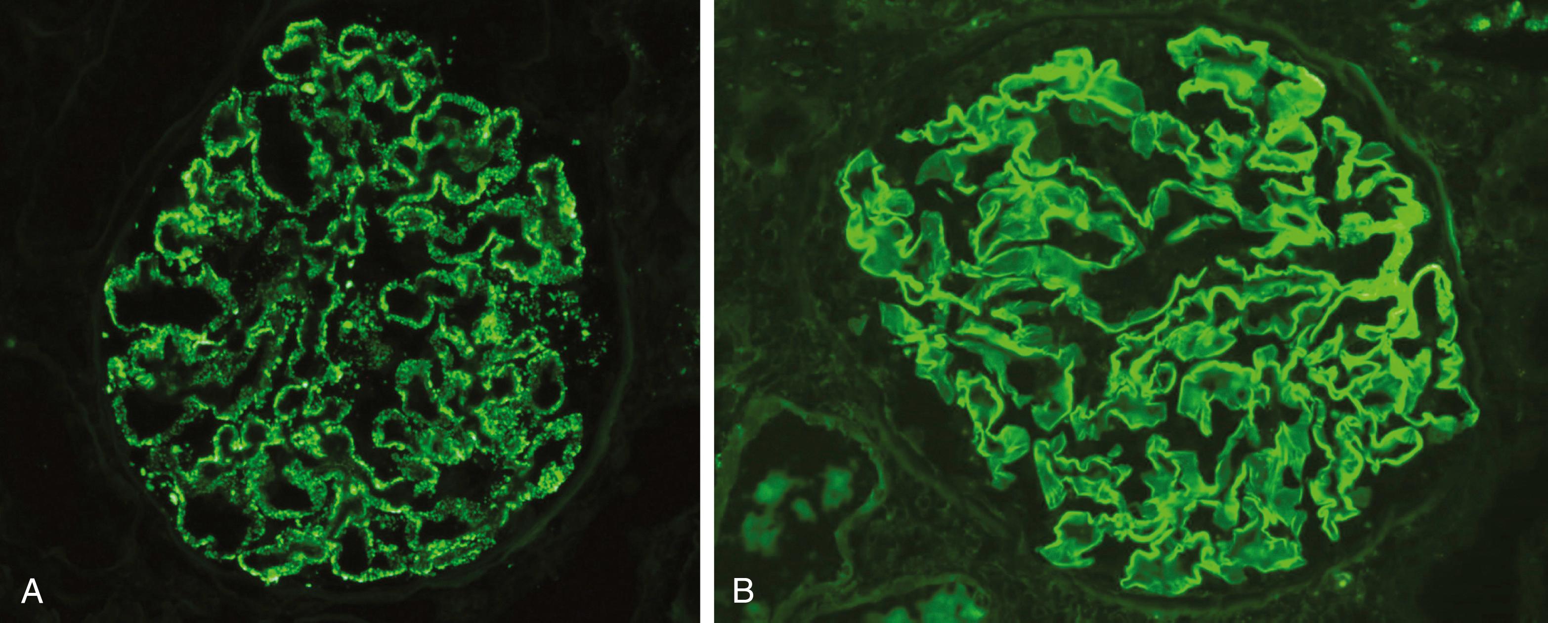 FIG. 12.3, Patterns of deposition of immune complexes as seen by immunofluorescence microscopy. (A) Granular, characteristic of immune complex deposition. (B) Linear, characteristic of antiglomerular basement membrane (anti-GBM) antibody deposition. (A, Courtesy of Dr. J. Kowalewska, Department of Pathology, University of Washington, Seattle, Washington.)