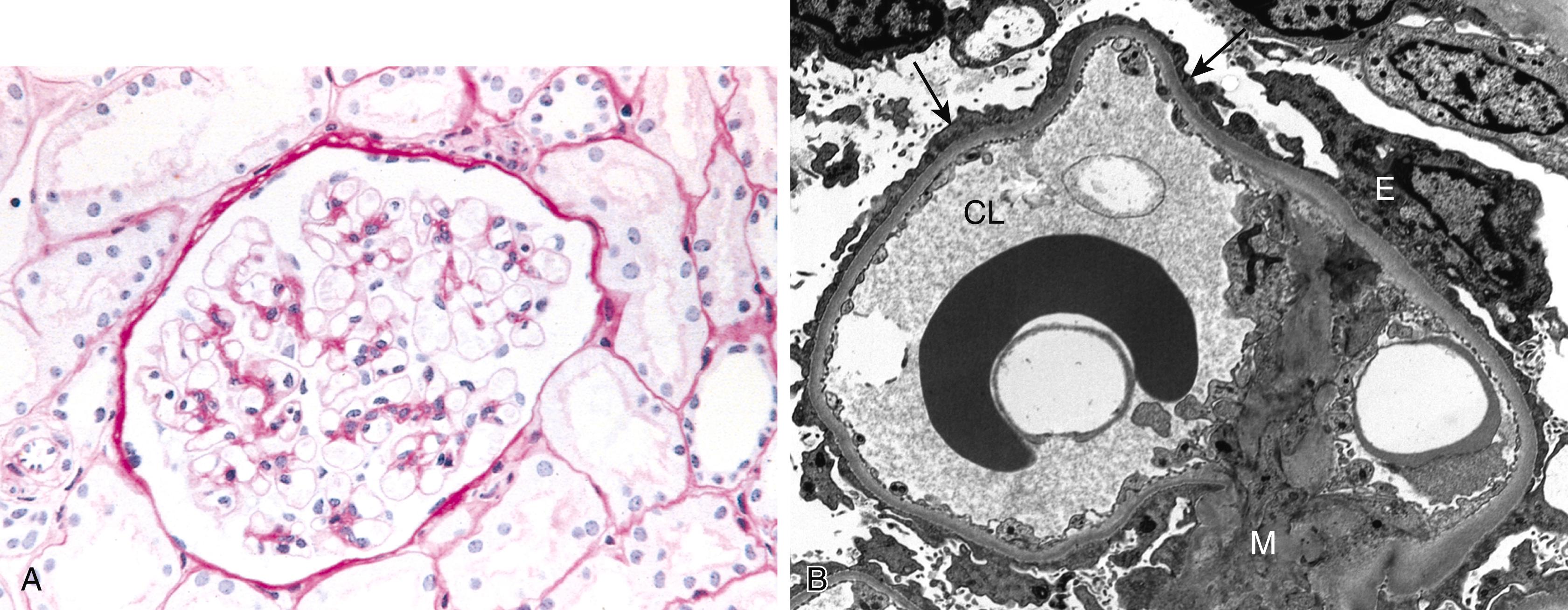 FIG. 12.4, Minimal change disease. (A) Glomerulus showing normal basement membranes and absence of proliferation (PAS stain, which highlights polysaccharides and glycoproteins). (B) Ultrastructural characteristics of minimal change disease include effacement of foot processes (arrows) and absence of deposits. CL , Capillary lumen; E , epithelial cell; M , mesangium.