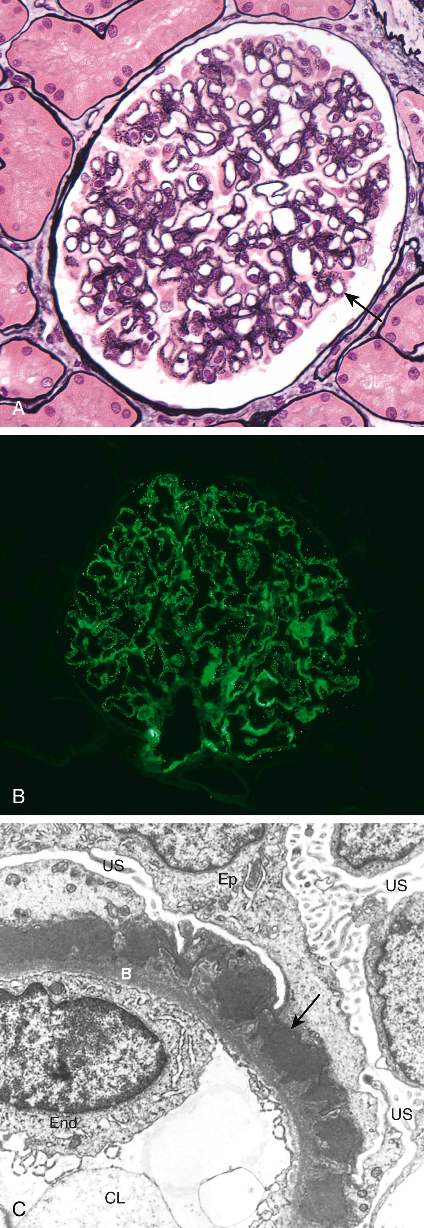 FIG. 12.6, Membranous nephropathy. (A) Diffuse thickening of the glomerular basement membrane without proliferation of cells or inflammation (silver stain, which highlights proteins in the GBM). (B) Granular deposits of IgG by immunofluorescence along the GBM. (C) Subepithelial deposits (arrow), effacement of foot processes, and the presence of spikes of basement membrane material between the immune deposits. B , Basement membrane; CL , capillary lumen; End , endothelium; Ep , epithelial cell; US , urinary space.