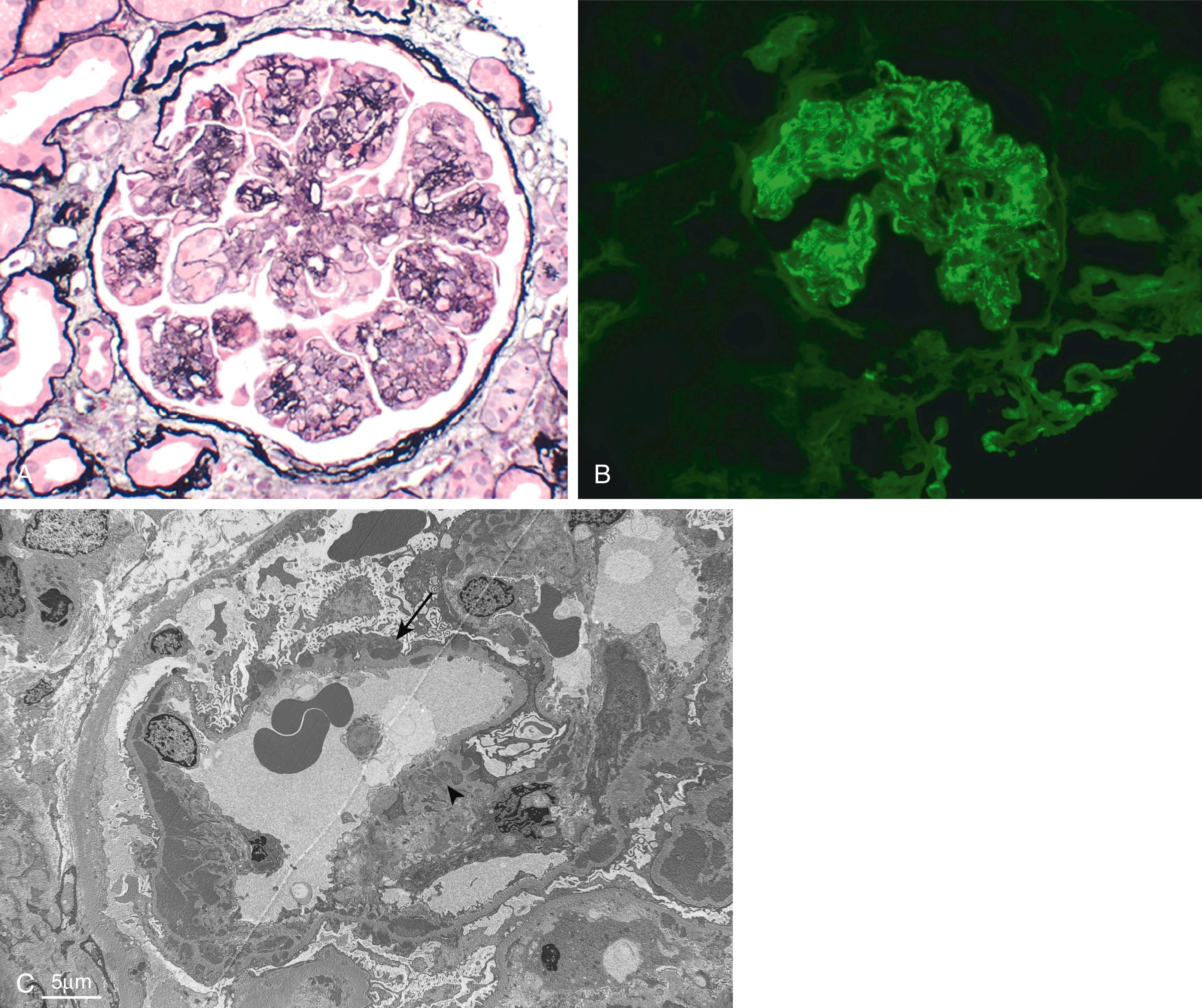 FIG. 12.7, Membranoproliferative glomerulonephritis (MPGN). (A) Mesangial cell proliferation, increased mesangial matrix (staining black with silver stain), basement membrane thickening with segmental splitting, accentuation of lobular architecture, swelling of cells lining peripheral capillaries, and influx of leukocytes (endocapillary proliferation) (silver stain). (B) Granular deposits of IgG in the GBM and mesangium. (C) Electron-dense deposits in the glomerular capillary wall between duplicated (split) basement membranes (arrow) and in mesangial regions (arrowhead) .