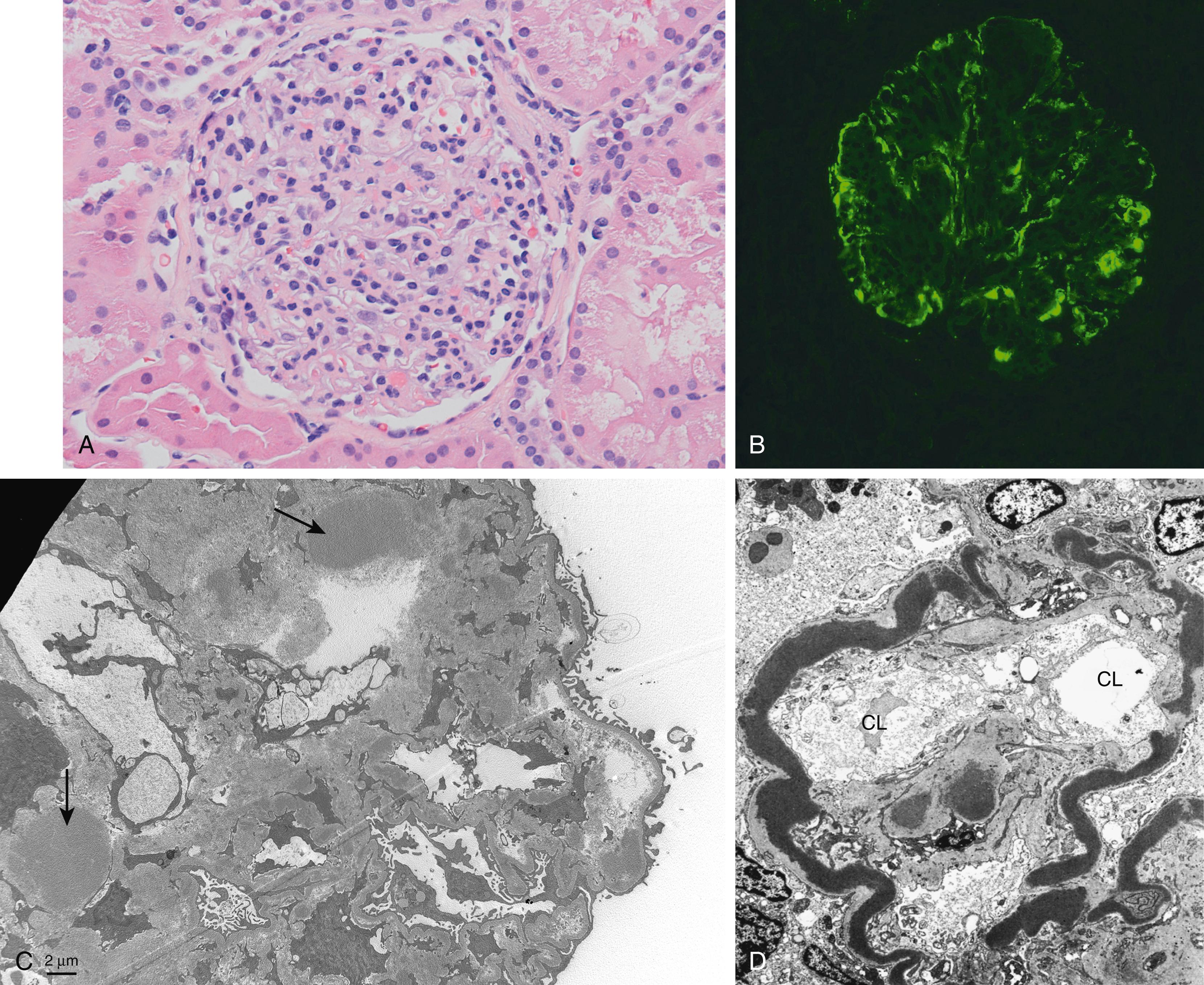 FIG. 12.8, C3 glomerulopathy. (A) Glomerulus showing hypercellularity and increased mesangial matrix. (B) Granular deposits of C3b in the GBM and mesangium. (C) “Waxy” electron-dense deposits in the mesangium (arrows) . (D) In dense deposit disease, there are dense homogeneous deposits within the basement membrane.