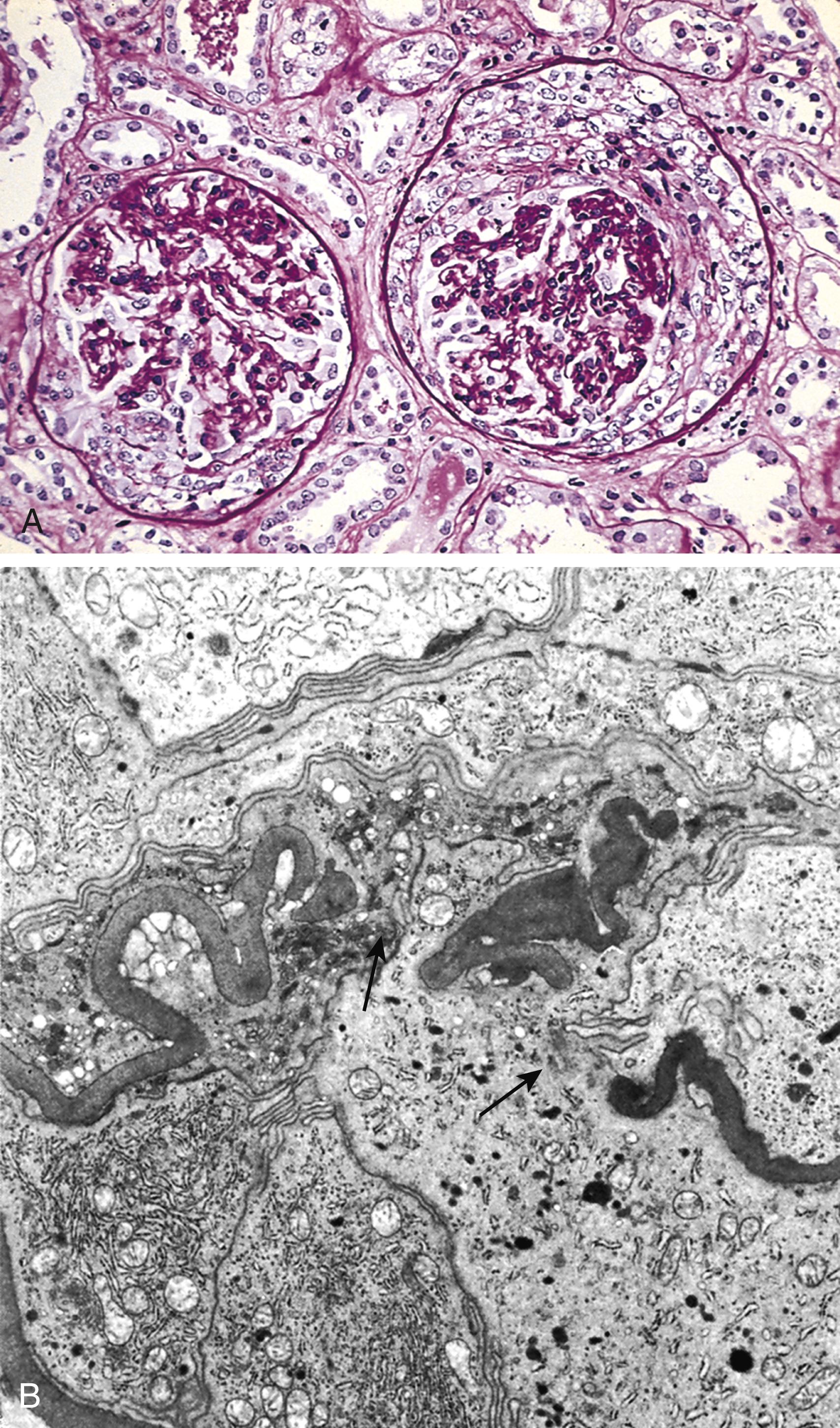 FIG. 12.10, Crescentic glomerulonephritis (A) Compressed glomerular tufts and crescent-shaped mass of proliferating epithelial cells and leukocytes within the Bowman capsule (PAS stain). (B) Electron micrograph showing characteristic wrinkling of glomerular basement membrane with focal disruptions (arrows).