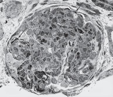 Figure 23.1, Plastic-embedded semi-thin section stained with toluidine blue showing numerous humps along the capillary walls (arrows) and obliteration of the glomerular capillary loops by endocapillary cell proliferation in a case of poststreptococcal glomerulonephritis.