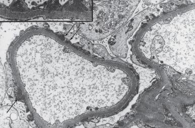 Figure 23.11, Membranous Glomerulonephritis, Stage I.