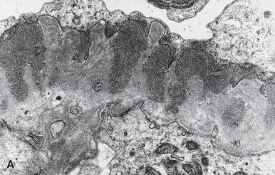 Figure 23.12, A, Membranous glomerulonephritis, stage II. Subepithelial deposits are separated by projections of the basement membrane (×18,000). B, Silver preparation showing spike formation along the thickened basement membrane (methenamine silver).