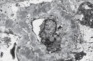 Figure 23.13, Membranous Glomerulonephritis, Stage III.