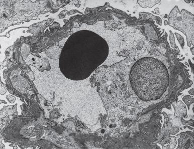 Figure 23.14, Membranous Glomerulonephritis, Stage IV.