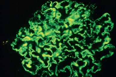 Figure 23.15, Immunofluorescence preparation of membranous glomerulonephritis showing peripheral granular deposits of IgG (anti-IgG).