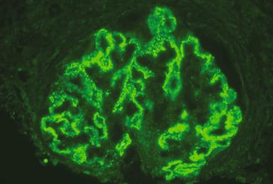 Figure 23.16, Diffuse granular capillary wall staining with antibody to PLA2R supports a diagnosis of primary membranous nephropathy (anti-PLA2R).