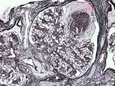 Figure 23.17, Diabetic glomerulosclerosis with segmental mesangial Kimmelstiel–Wilson nodule and adjacent microaneurysm. Other mesangial areas have mild diffuse mesangial sclerosis. Arteriolar hyaline insudation is seen near the vascular pole (methenamine silver stain).