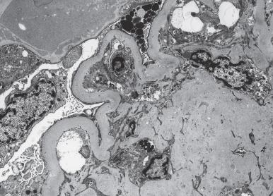 Figure 23.18, Nodular Diabetic Glomerulosclerosis.