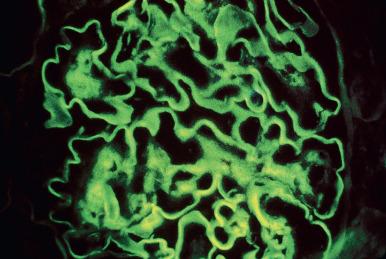 Figure 23.19, Diabetic glomerulosclerosis with linear staining for IgG along the glomerular basement membrane (anti-IgG).