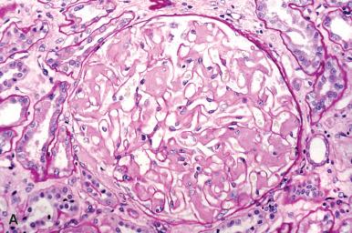 Figure 23.20, Acellular Amorphous Deposits of Amyloid in the Mesangium With Patchy Glomerular Capillary Wall Extension.