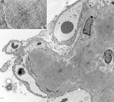 Figure 23.22, Portion of a glomerulus with large amounts of mesangial deposits of amyloid. The typical fibrillary ultrastructural appearance of the amyloid fibrils is shown at high magnification (×5000; inset ×54,000).