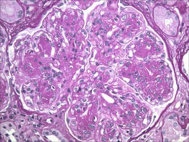 Figure 23.24, Biopsy from a patient with light chain deposition disease showing nodular mesangial lesions resembling those of diabetes mellitus.