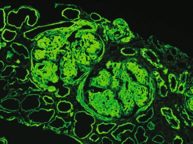 Figure 23.25, Light Chain Deposition Disease.