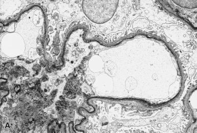 Figure 23.26, Light Chain Deposition Disease.