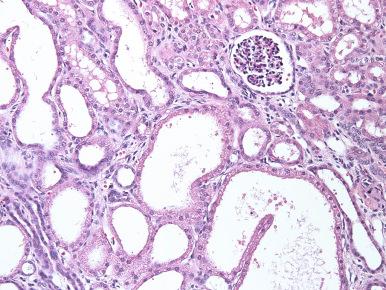 Figure 23.27, Microcystic dilation of proximal tubules and interstitial scarring in a 1-year-old child with congenital nephrotic syndrome, Finnish type.