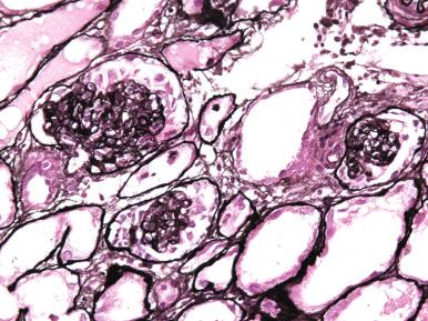 Figure 23.28, Mesangial sclerosis and consolidation with prominent overlying podocytes are typical for diffuse mesangial sclerosis (methenamine silver).