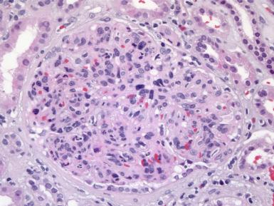 Figure 23.29, Diffuse Proliferative Glomerulonephritis.