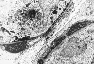 Figure 23.30, Biopsy From a Patient With Acute Poststreptococcal Glomerulonephritis.