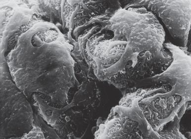 Figure 23.3, Scanning electron micrograph showing the capillary loops covered by visceral epithelial cells and interdigitating foot processes (×8000).