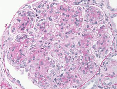 Figure 23.32, Membranoproliferative Pattern Glomerulonephritis.