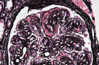 Figure 23.33, Silver preparation showing marked increase in mesangial matrix in the centrolobular areas with peripheral extension of the mesangium producing a double contour (membranoproliferative) pattern in the loops (methenamine silver).