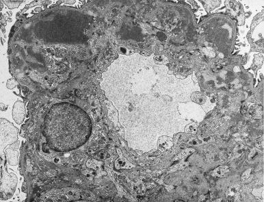 Figure 23.34, Glomerular capillary loop from a patient with membranoproliferative pattern glomerulonephritis showing peripheral extension of the mesangium into capillary loop, basement membrane duplication, and subendothelial deposits (×5400).