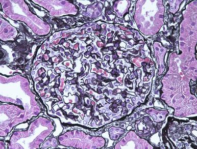 Figure 23.4, Glomerulus From a Patient With Minimal Change Disease.