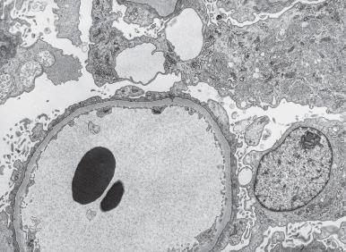 Figure 23.5, Portion of a glomerulus from a patient with minimal change disease showing obliteration of foot processes. The visceral epithelial cell cytoplasm shows microvillus and cyst formation (×8400).