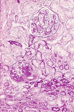 Figure 23.7, Biopsy From a Patient With Focal and Segmental Glomerulosclerosis.